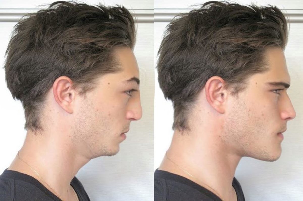 Рост волос на шее у мужчин